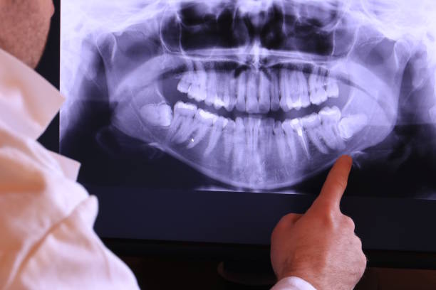 Best Emergency Wisdom Teeth Removal in Bent Creek, NC