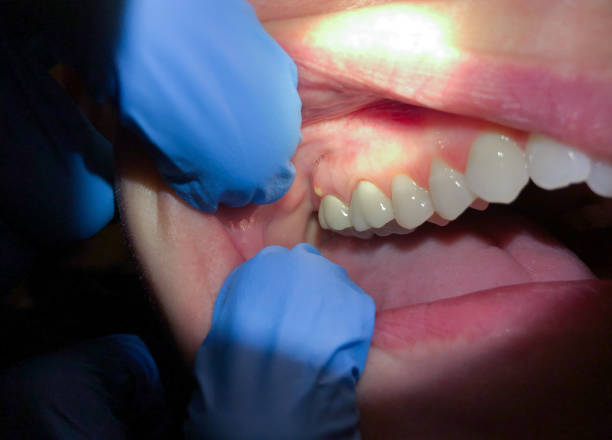 Best Emergency Treatment for Toothache in Bent Creek, NC